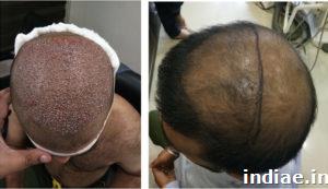Best Hair Transplant In Punjab, Hair Transplant In Nawanshahr in Ludhiana