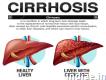 Effective Liver Cirrhosis Treatment in India