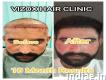 Vizox Clinique: the Best Hair Transplant Clinic in