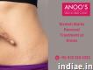 Advanced Stretch Marks Removal Treatment at Anoos