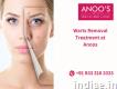 Advanced Warts Removal Treatment at Anoos